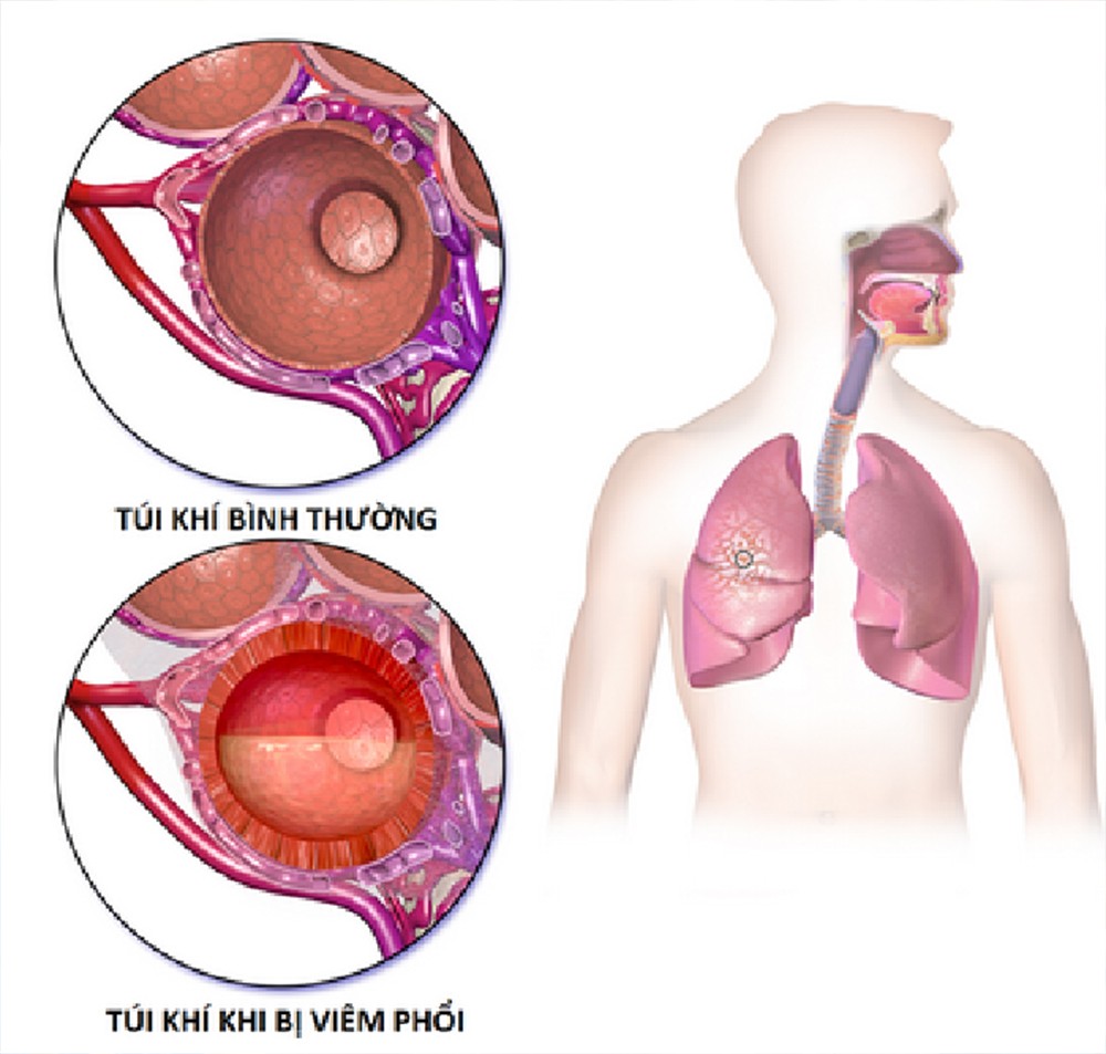 ​Dưỡng âm thanh phế thang - phương thuốc quý hồi phục tốt sau viêm phổi