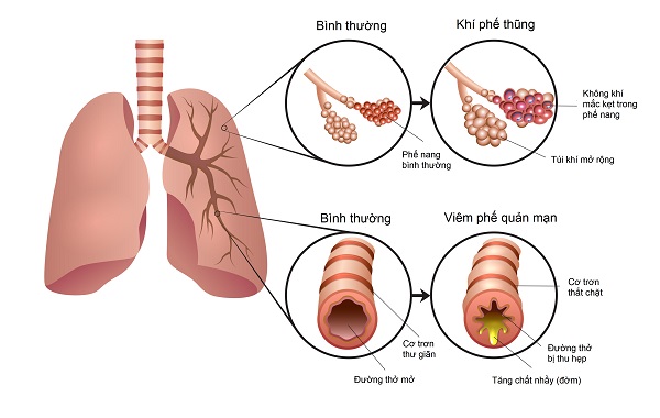 Phân biệt bệnh COPD với bệnh lao phổi