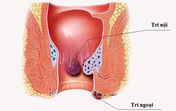Trĩ không chỉ là một búi mạch máu phình giãn - Đó là biểu hiện của sự mất cân bằng kéo dài trong cơ thể